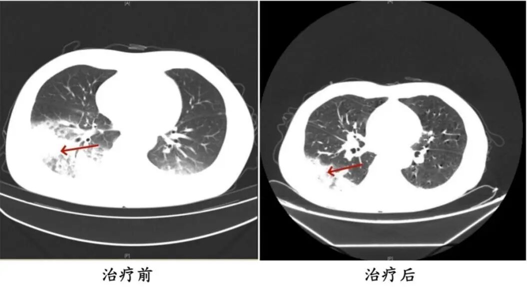 开了一晚上空调，女子高烧不退、肺白了大半！医生紧急提醒 - 图4