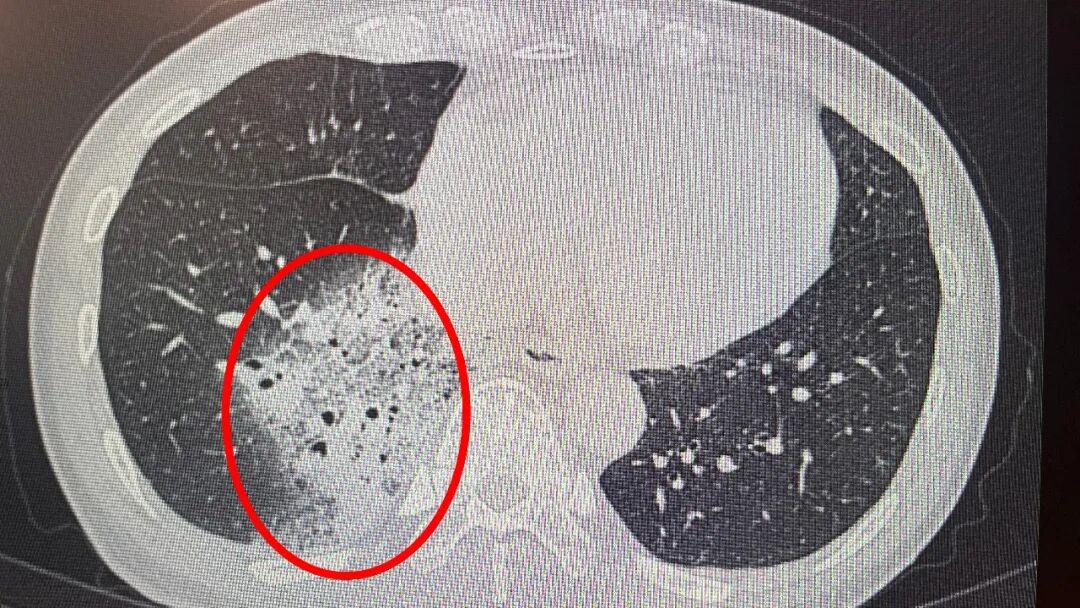 开一晚上空调，杭州一女子高烧不退，肺“白”了大半！医生提醒：“军团菌”藏身空调，很多人忽视了 - 图1