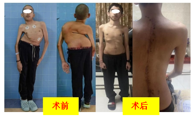 守护青春脊梁｜新苗公益十六周年活动圆满举行，杨军林教授医疗团队成果彰显 - 图4