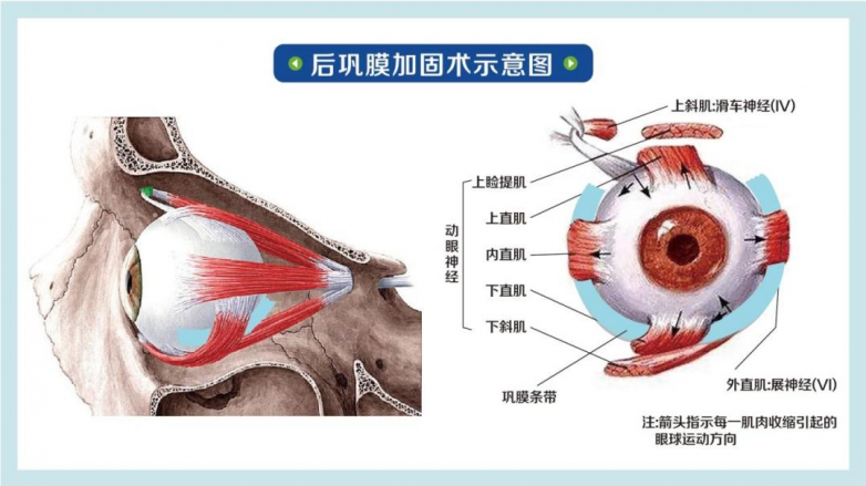 6岁女童近视超千度！爱尔儿童眼科何勇川实施“后巩膜加固术”控进展 - 图3
