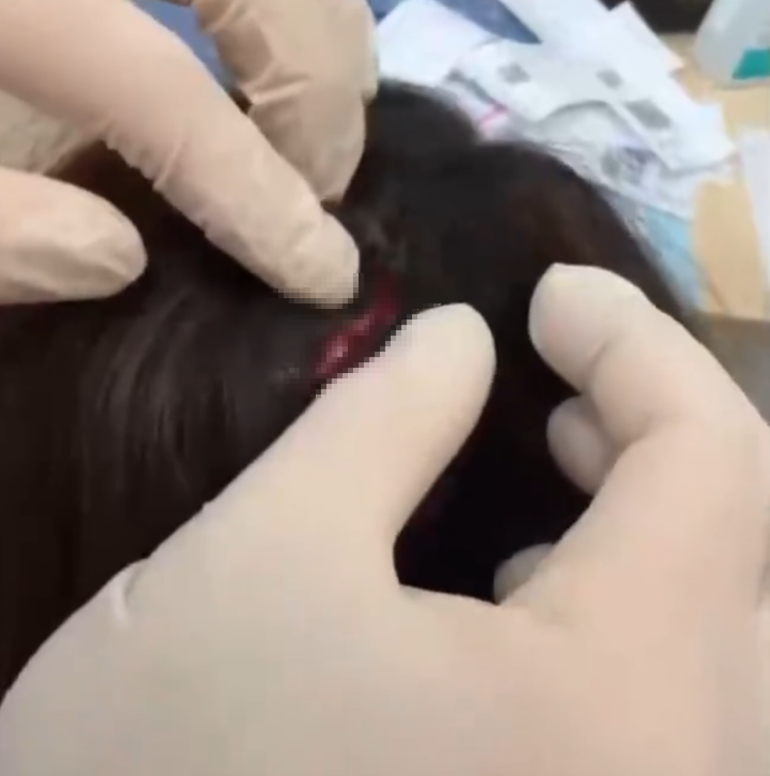 女子被自家养了2年的猫咪疯狂攻击，面颈部多处挫裂伤，头皮伤口约4公分：打了6针狂犬疫苗 - 图4