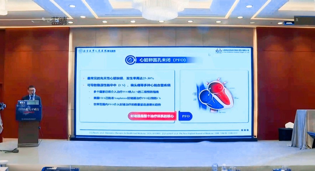 全球首款“全显影可降解”PFO封堵器在青岛开启临床试验 - 图1