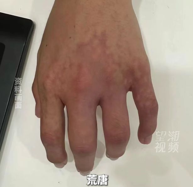 一老板觉得“指缝宽漏财”，竟往手指里打玻尿酸！财没聚到，差点截肢！ - 图2