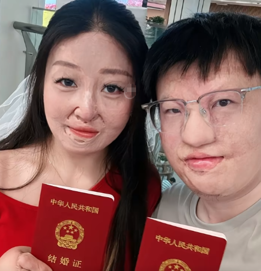 浙江一对烧伤情侣在527晒结婚照：两人各自在幼年时受伤，2年前刷到妻子账号被吸引，现在感觉很幸福 - 图3