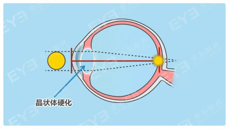 近视能抵消老花？老花可以矫正？上海爱尔眼科专家来解答！ - 图1