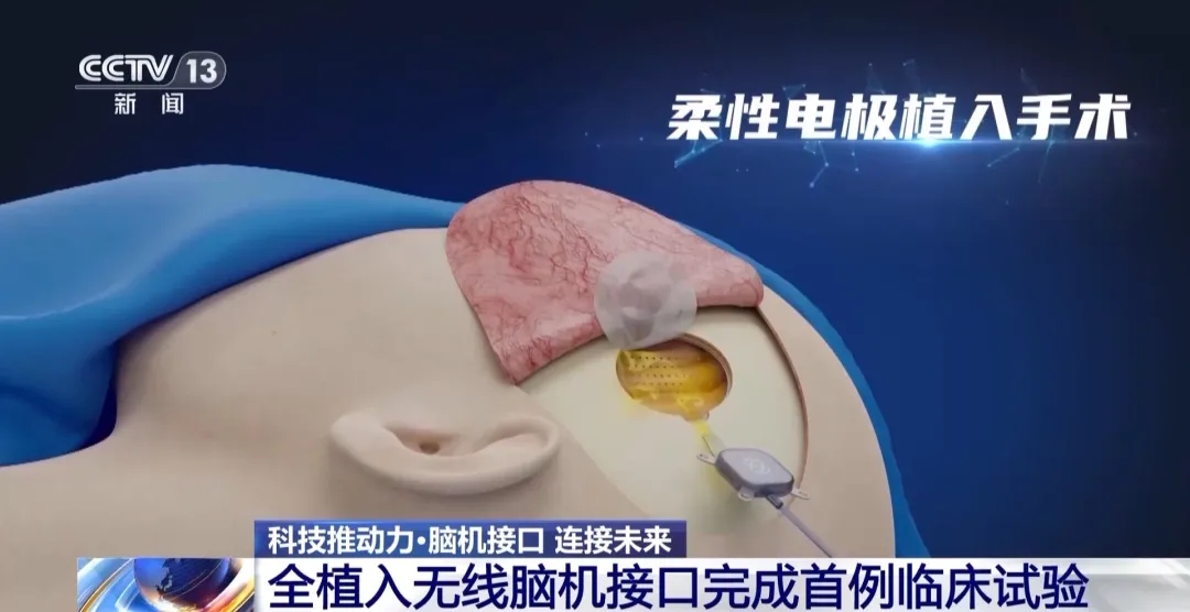 观潮的螃蟹丨脑机接口，湖南怎么接？ - 图8