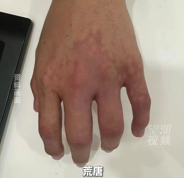 一老板觉得“指缝宽漏财”，竟往手指里打玻尿酸！财没聚到，差点截肢 - 图2