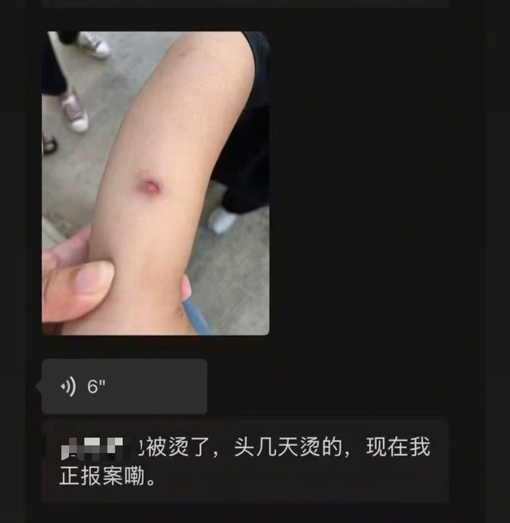 徐州丰县一幼儿园教师疑用热熔胶枪烫伤幼儿，当地教育部门：已立案处置，工作人员正在现场调查 - 图2