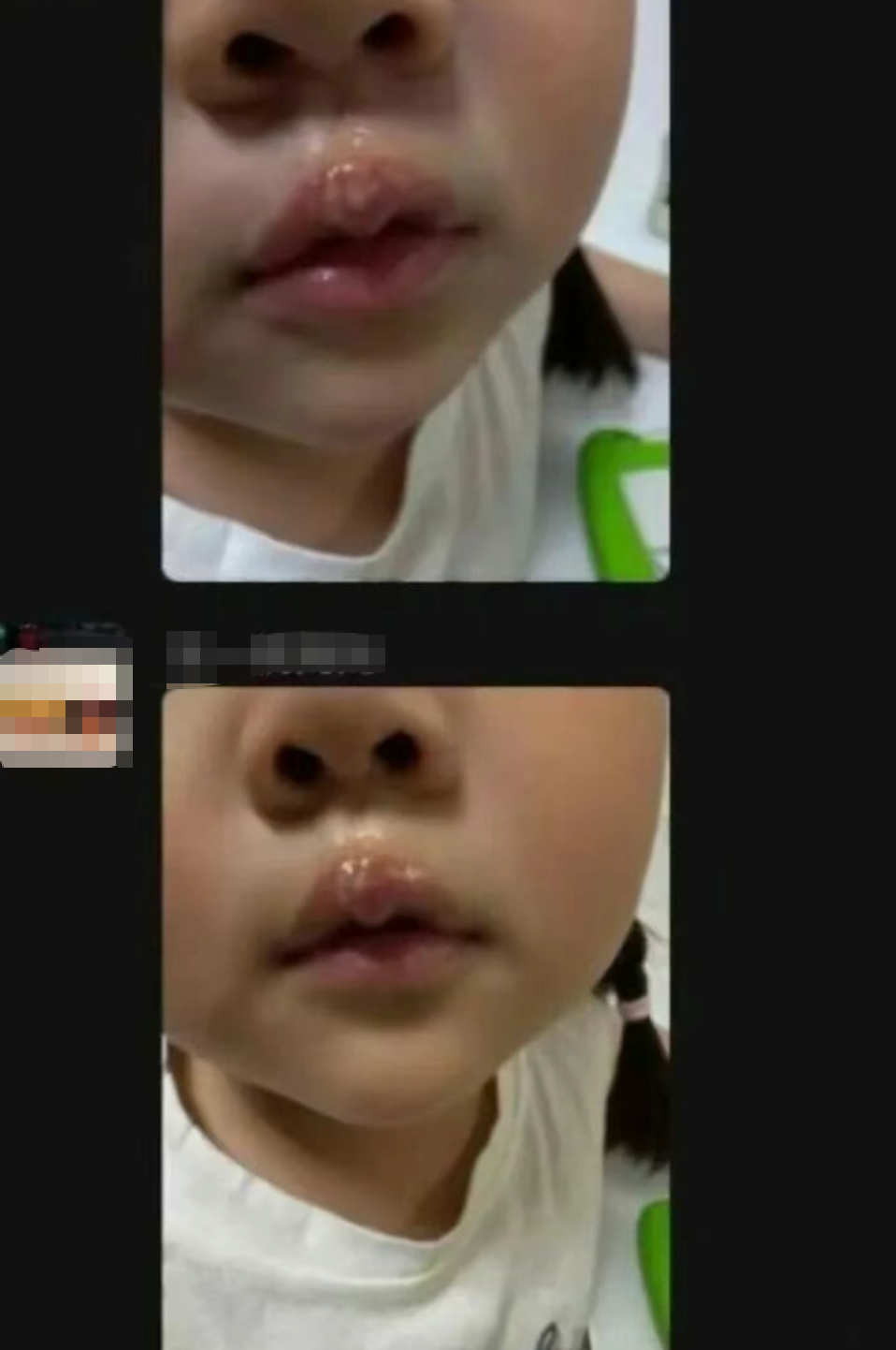 幼儿园女童被老师用热熔胶棒烫嘴虐待，江苏丰县教育局：涉事教师已被停职，公安部门已立案调查 - 图1