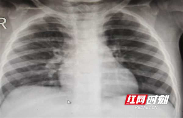 医疗服务提升年丨永州市中心医院儿科成功为1岁患儿取出支气管异物 - 图2