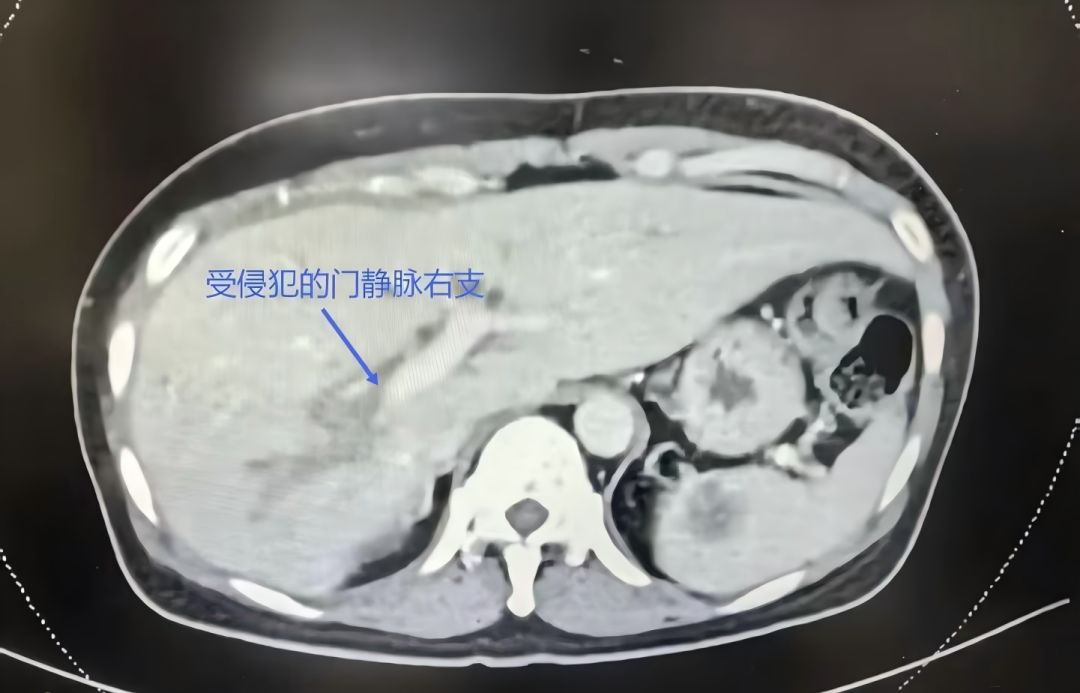 睡不着，想拿钢丝球搓！女子长期熬夜吃外卖，皮肤黄、浑身痒，竟确诊“癌王” - 图2