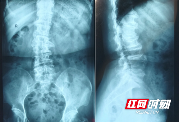 六旬老人“弯”了的腰，不一定都要“大手术” - 图1