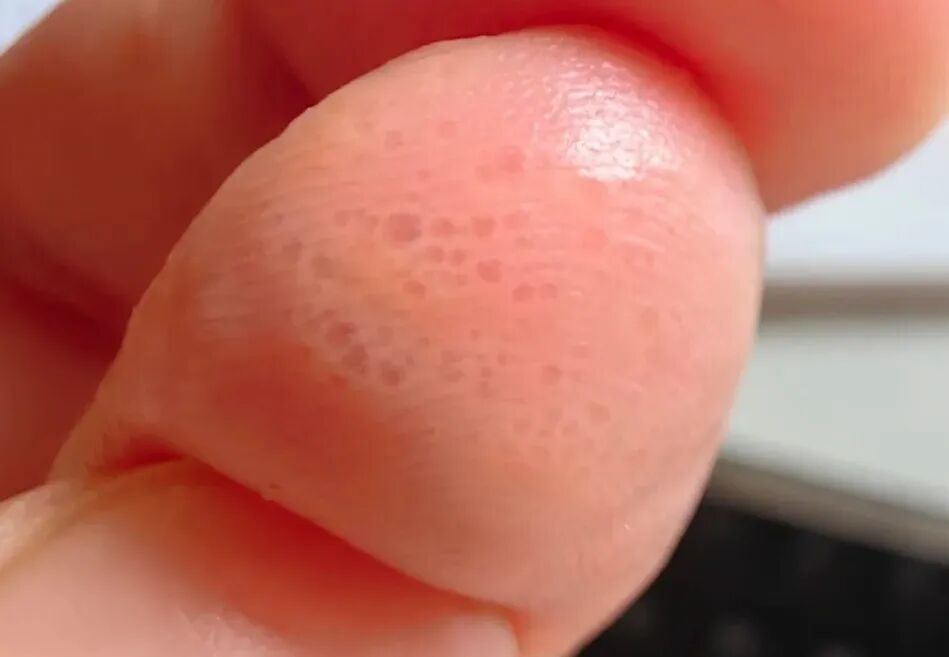 奇痒无比！这种夏天手上爱长的小水疱，到底是什么？ - 图3