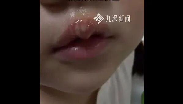 幼儿园老师用热熔胶枪烫伤孩子？当地通报：已停职，警方立案调查 - 图3
