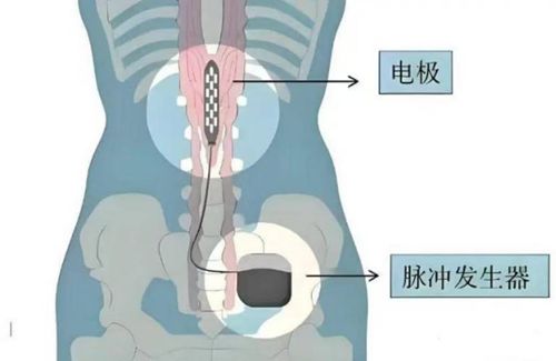 湘雅三医院神经外科成功开展脊髓电刺激术 助偏瘫患者重获行走能力 - 图1
