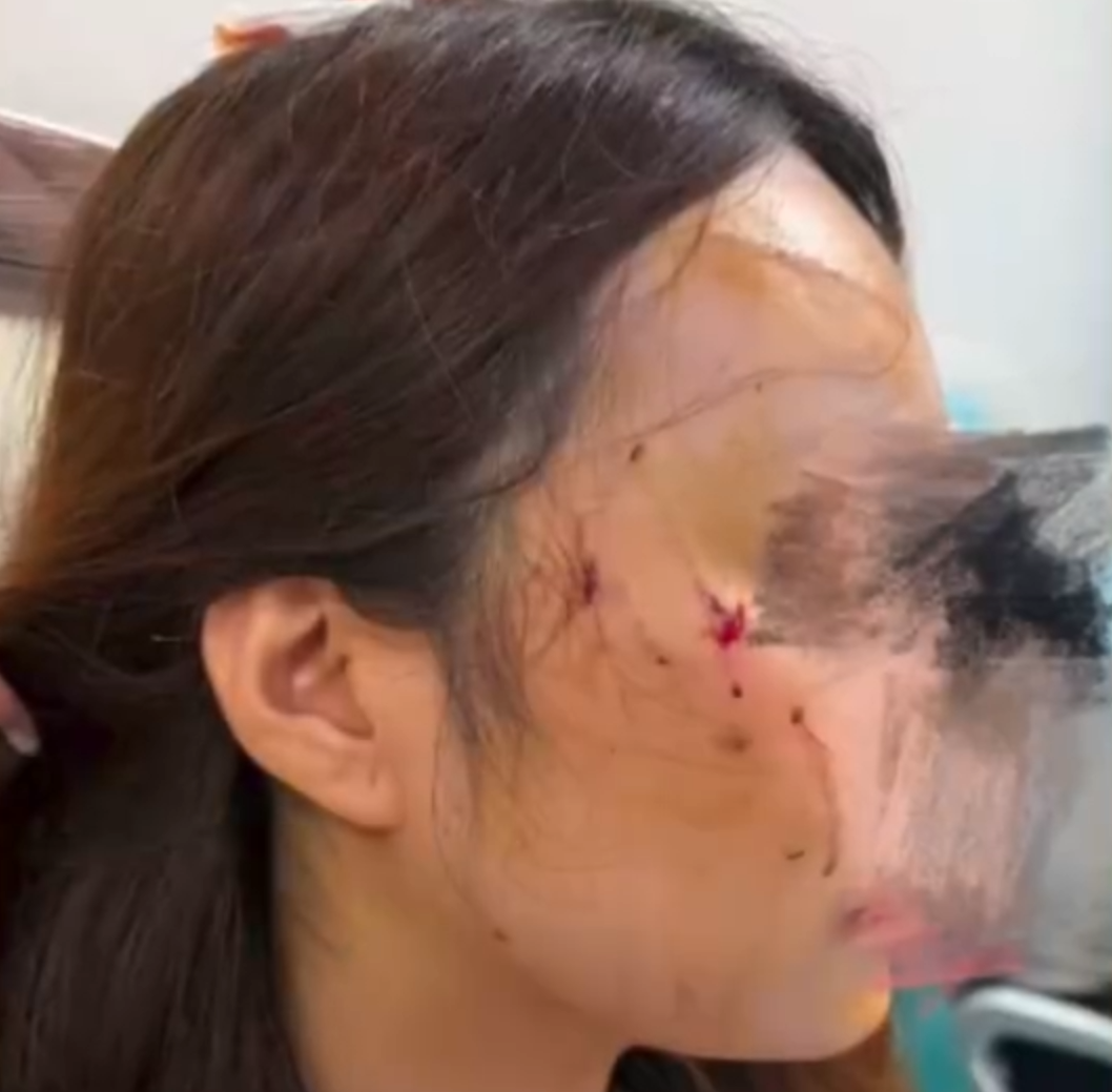 女子被自家养了2年的猫咪疯狂攻击，面颈部多处挫裂伤，头皮伤口约4公分：打了6针狂犬疫苗 - 图2