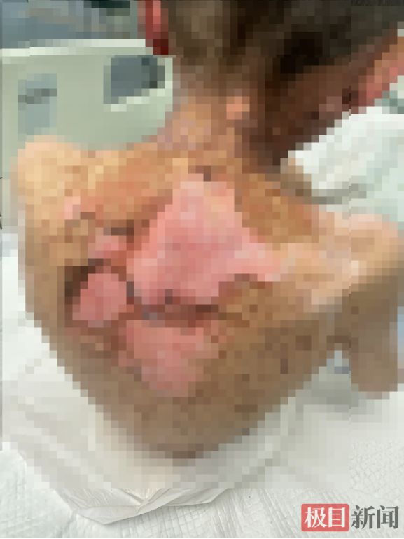 家长警惕！9岁男孩全身大面积皮肤剥脱、血痂粘嘴眼……元凶竟是家中常用药 - 图1
