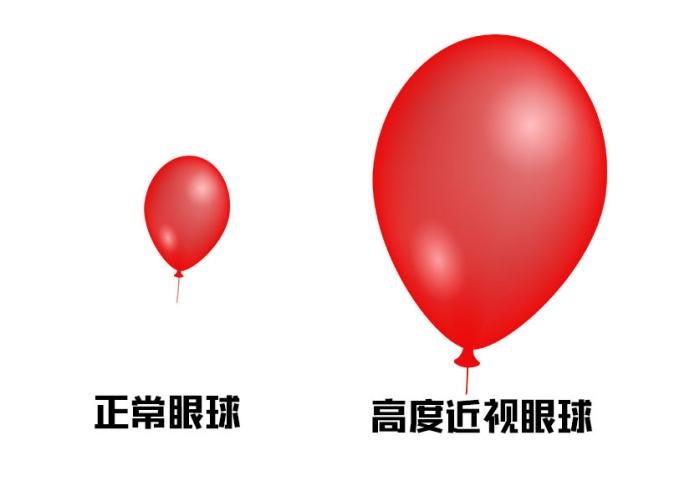 6岁女童近视超千度！爱尔儿童眼科何勇川实施“后巩膜加固术”控进展 - 图1