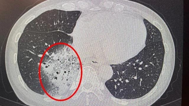 开了一晚上空调，女子肺白了大半！医生紧急提醒 - 图1